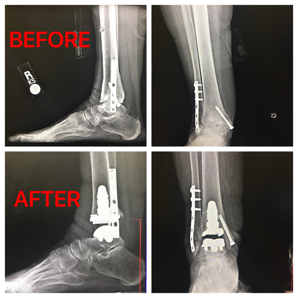 Total ankle replacement before & after